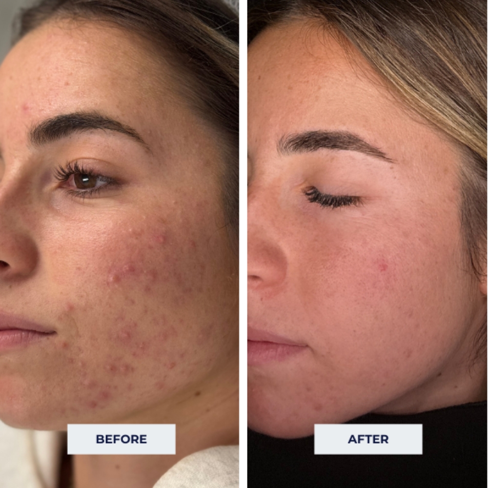 Acne Facial at 121 Studio in Marshall, IL
