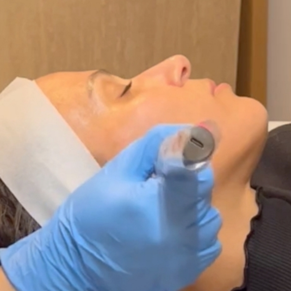 Microneedling