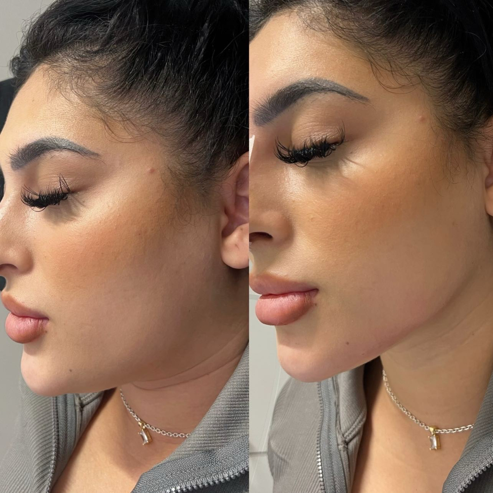 Jawline Contouring at Lips And Hips Beauty Bar in Modesto, CA