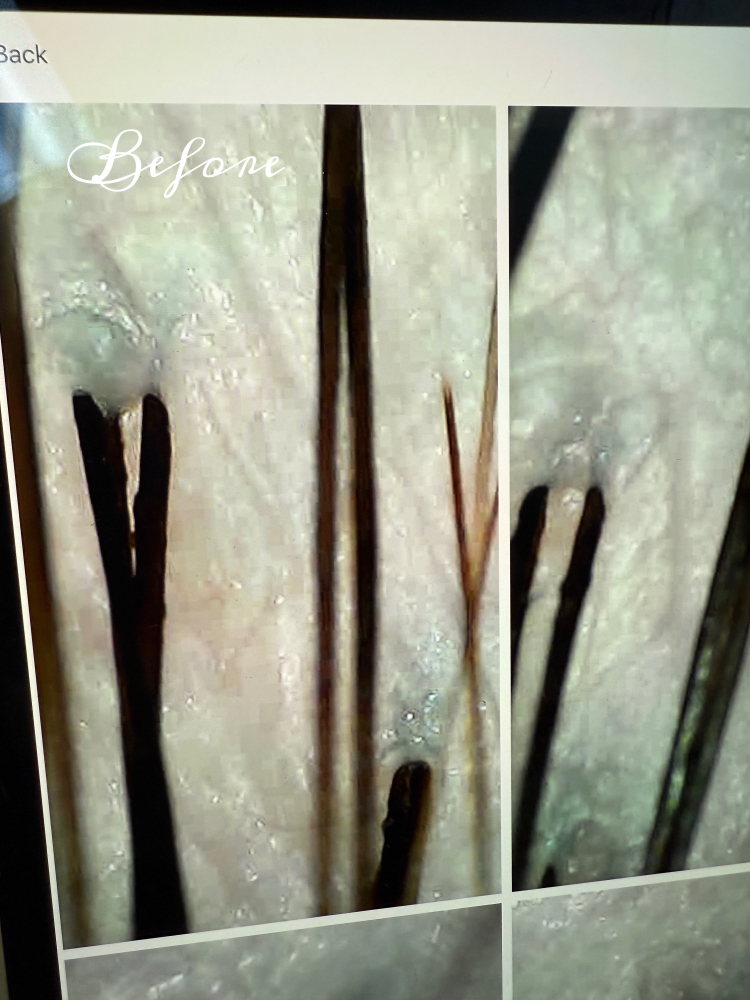 Scalp Anaysis Pics With Treatment