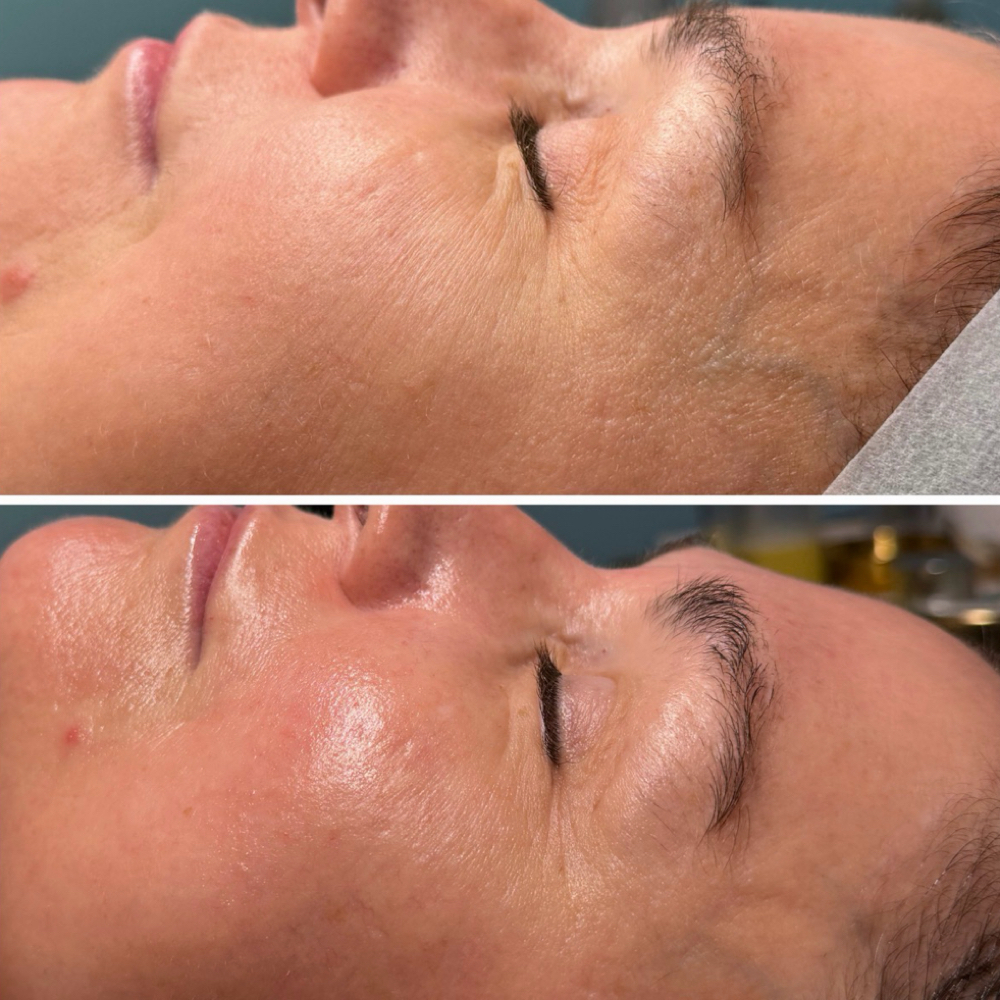 Skinplicity “Transform” at Skinplicity Facial Spa in Jurupa Valley, CA