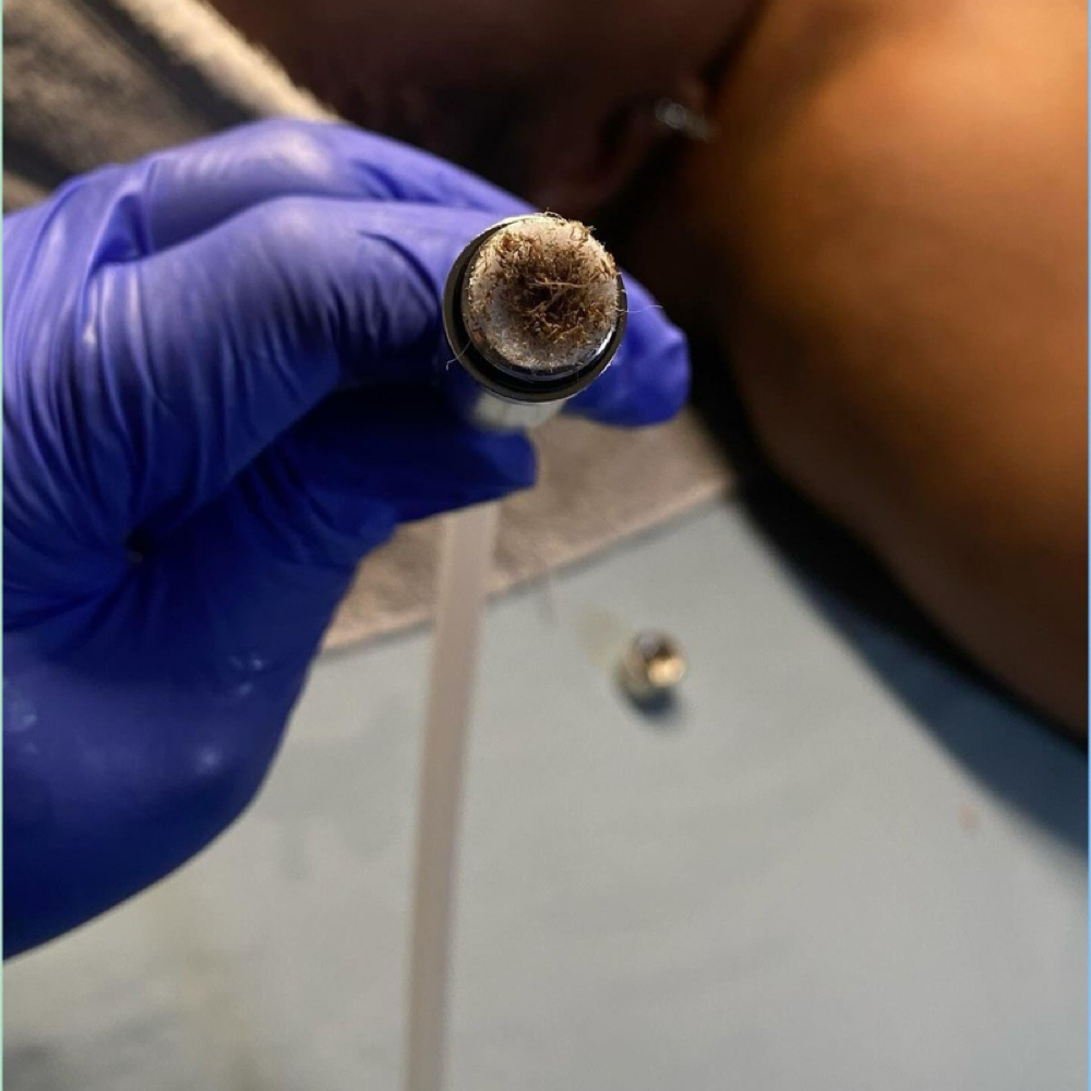 MICRODERMEBRASION FACIAL at Precision skin and Wellness Lab in Tallahassee, FL