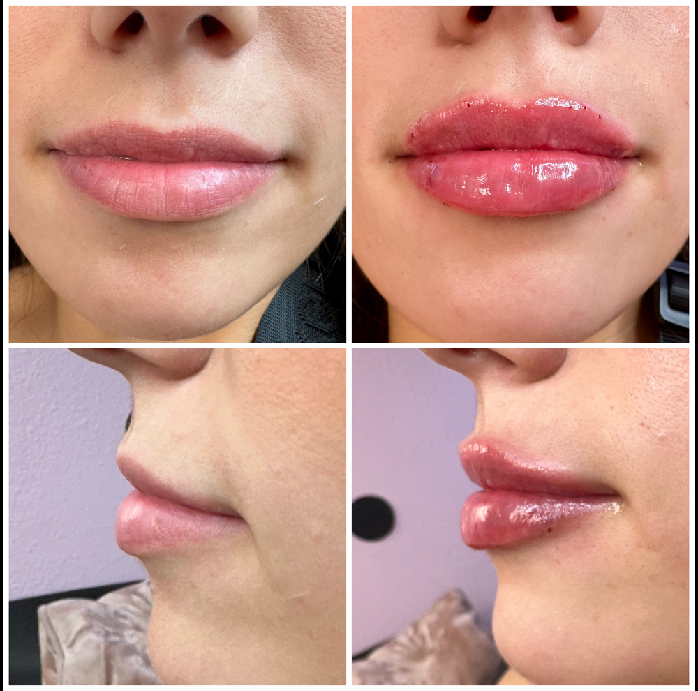 Lip Filler Full Syringe