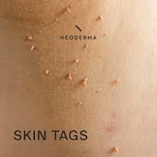 Single Thorn (Skin Tag/DPN)