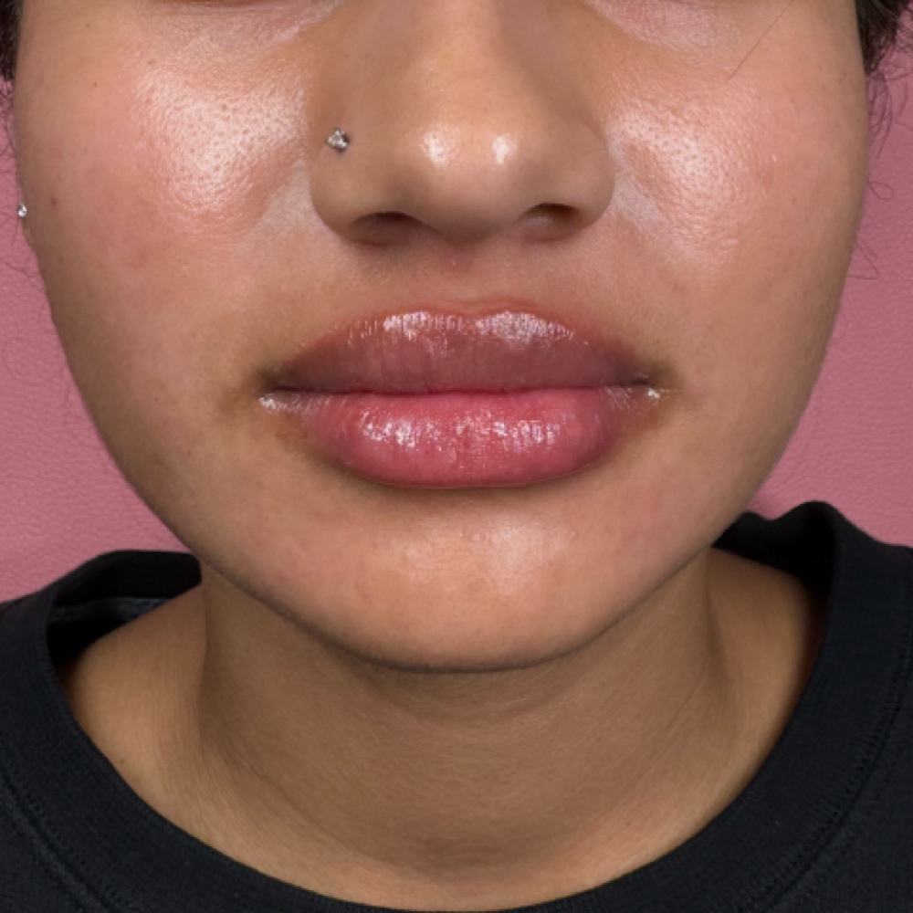 1 ML Needle-less Lip Enhancement at divinebeautyarizona in Phoenix, AZ