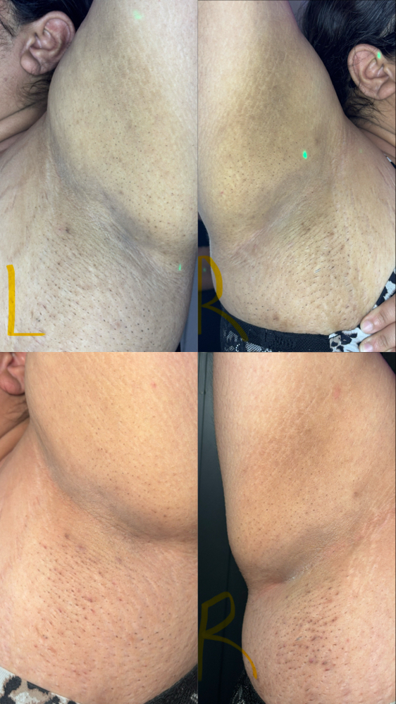 Under Arms Brightening