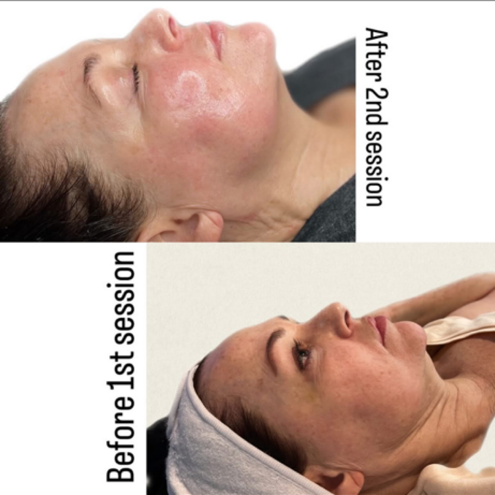 Face Lift Sessions (3) at Bare Beauty By Alexis in Bay Saint Louis, MS