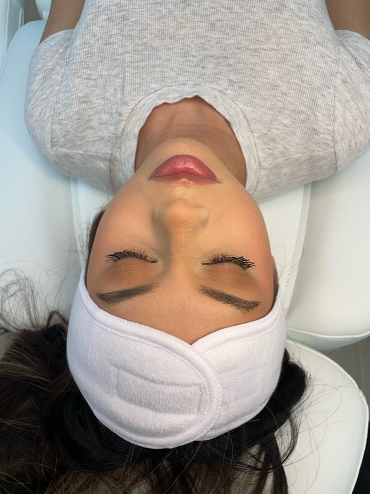 RF Microneedling