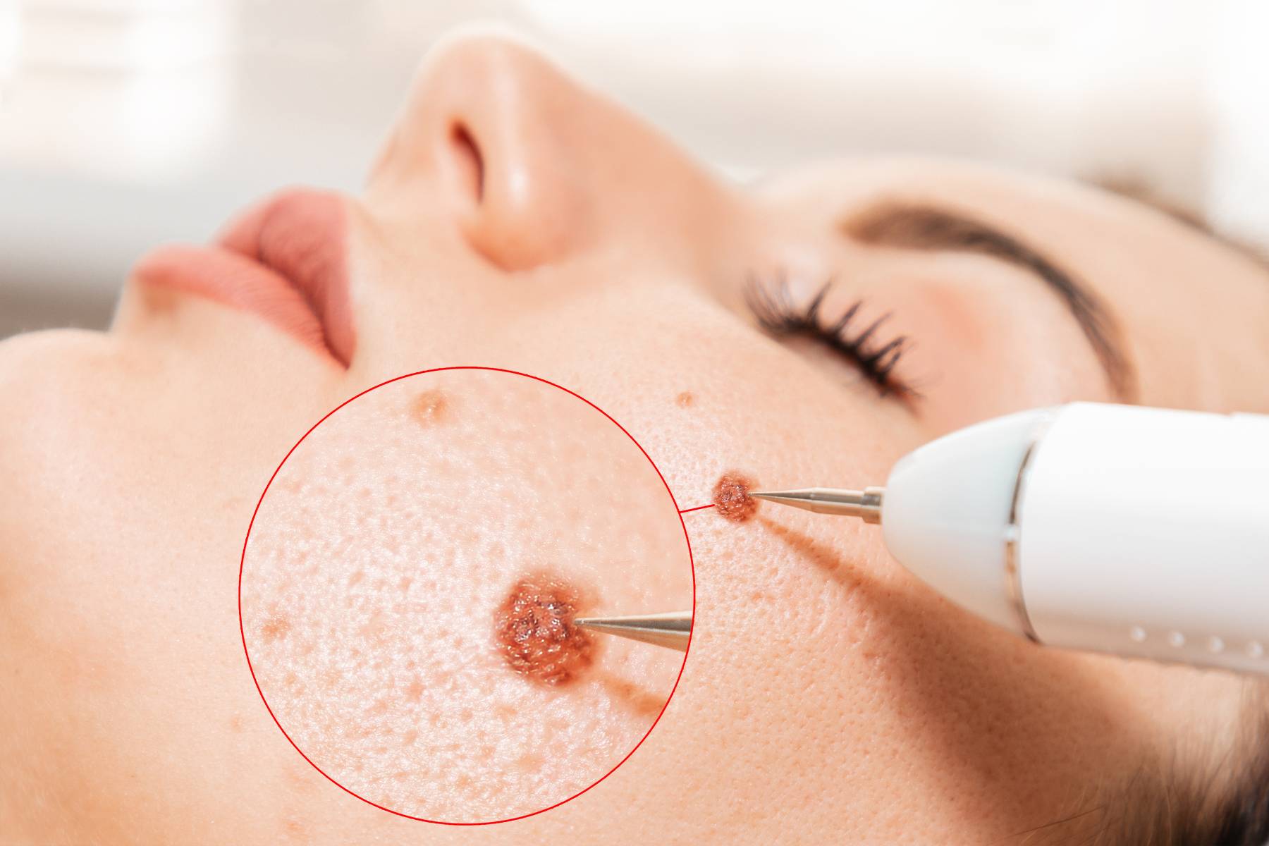 Skin tag & Wart Removal