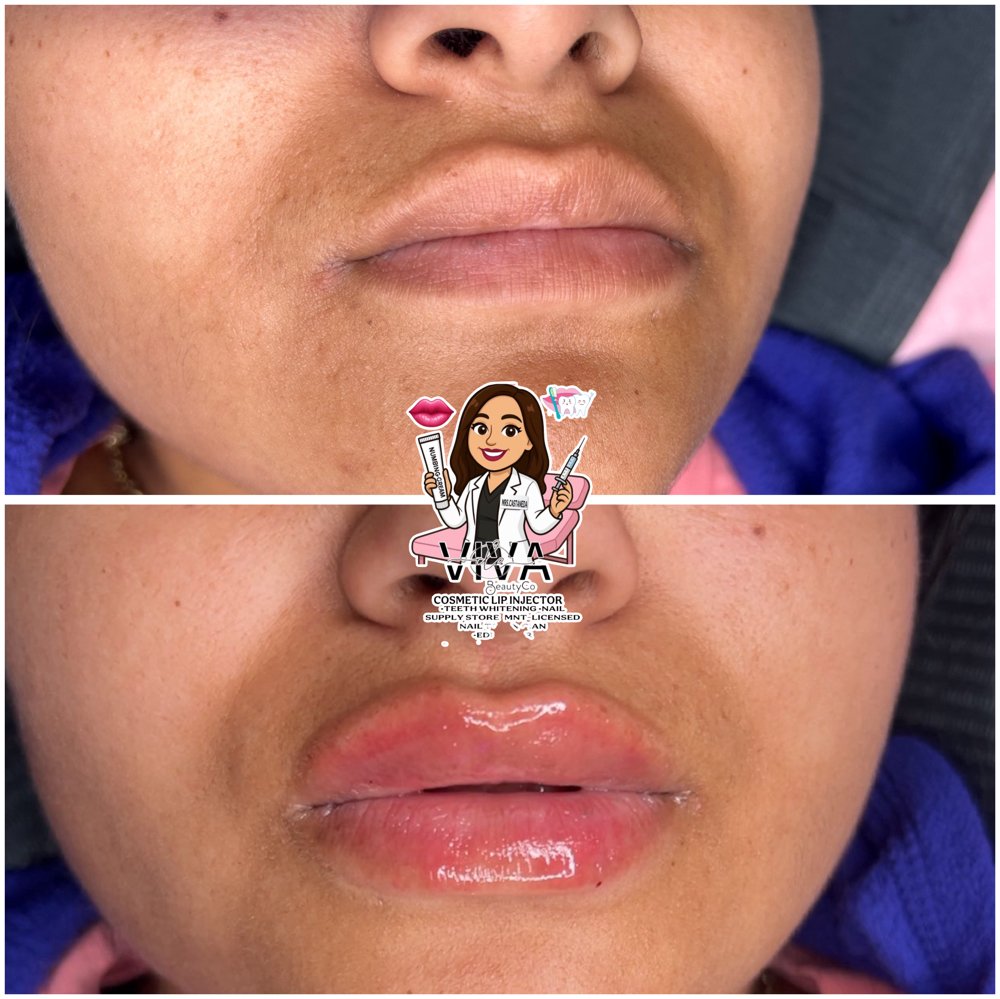MODEL FOR MICRO LIP FILLER