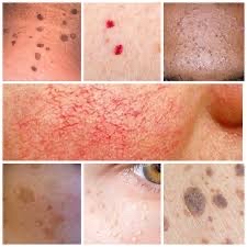 Skin Classic Spot Removal(2-4 spots