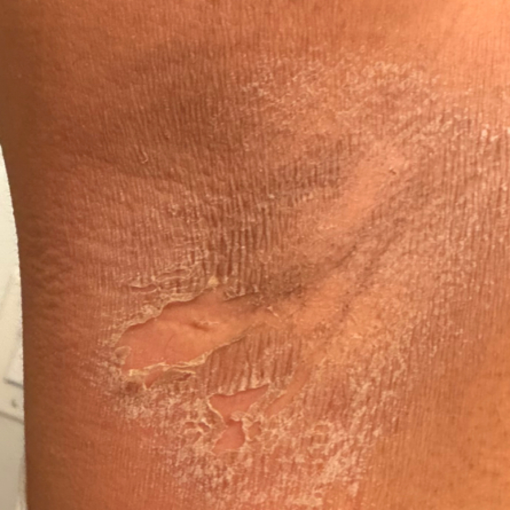 Underarm Lightening ( One Session ) at Studio Belvia in Scottsdale, AZ