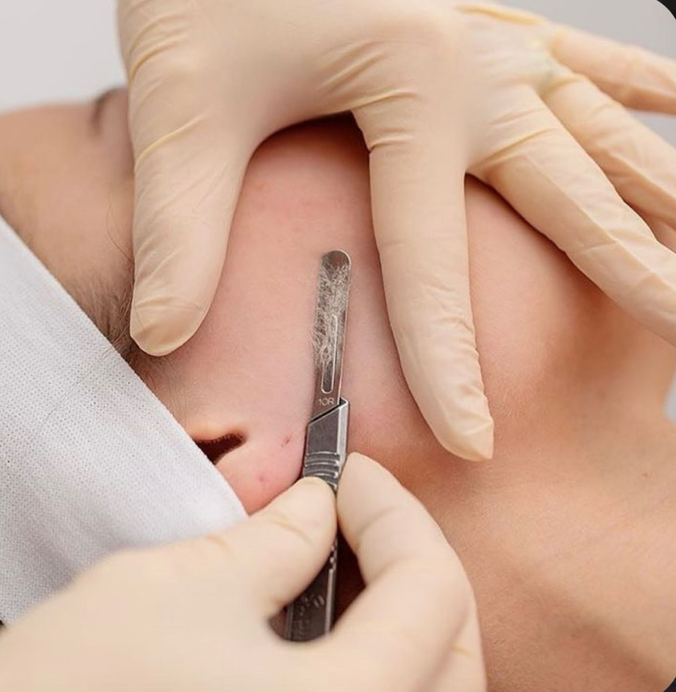 Dermaplane Add-On