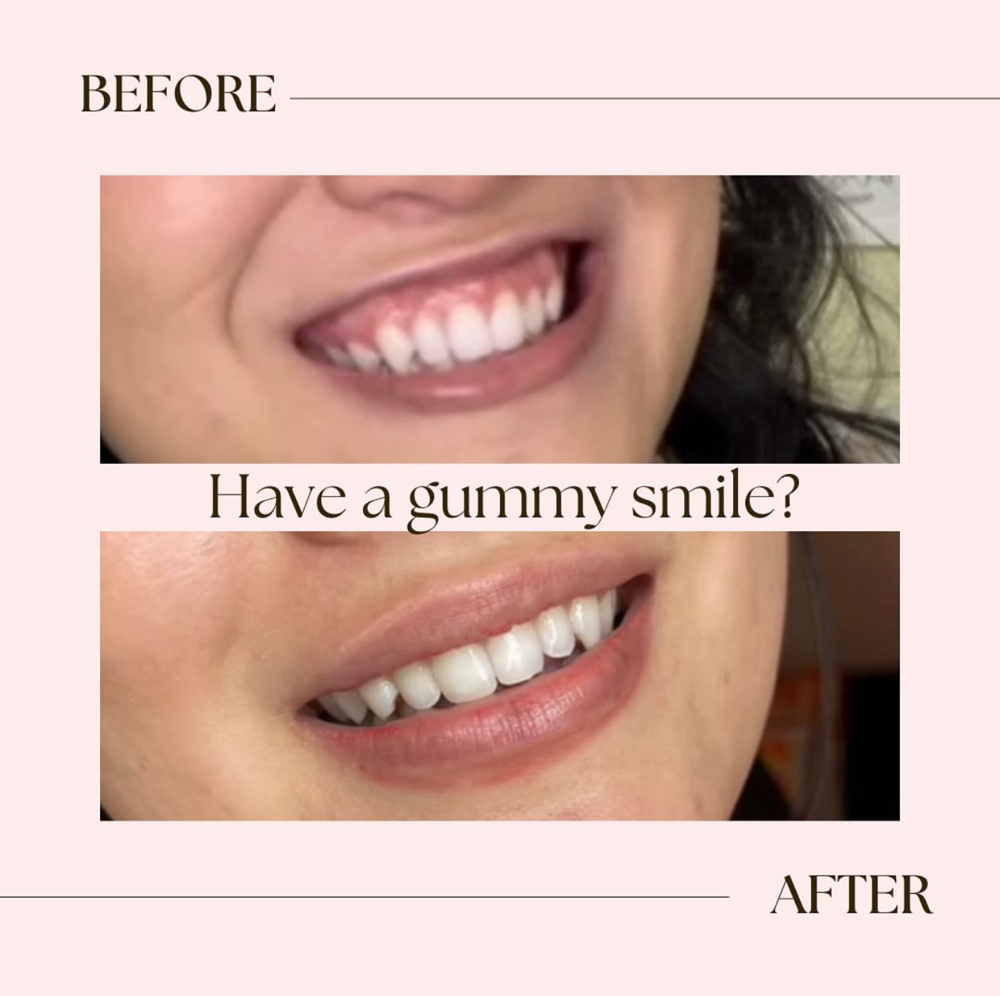 Lip Flip at AlyZel Aesthetics & Wellness in Plainview, TX