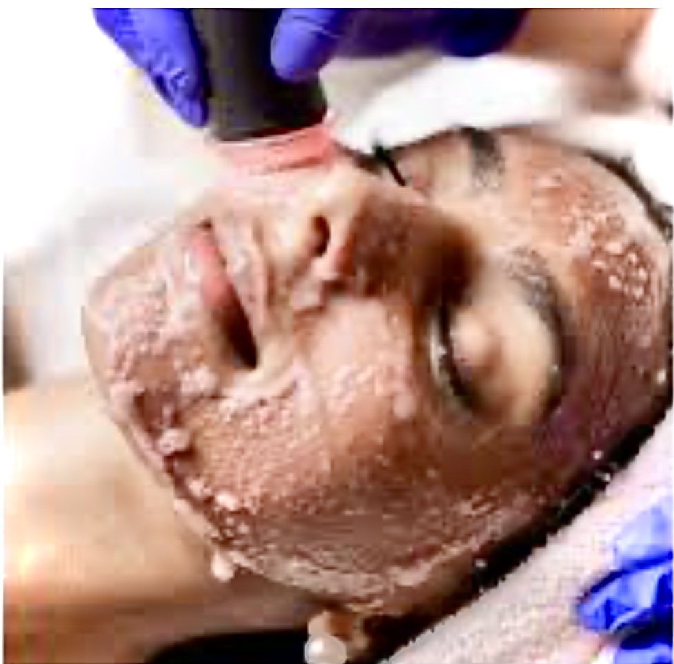 (Deluxe) C02 Bubble Facial