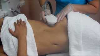 Ultrasound Cavitation