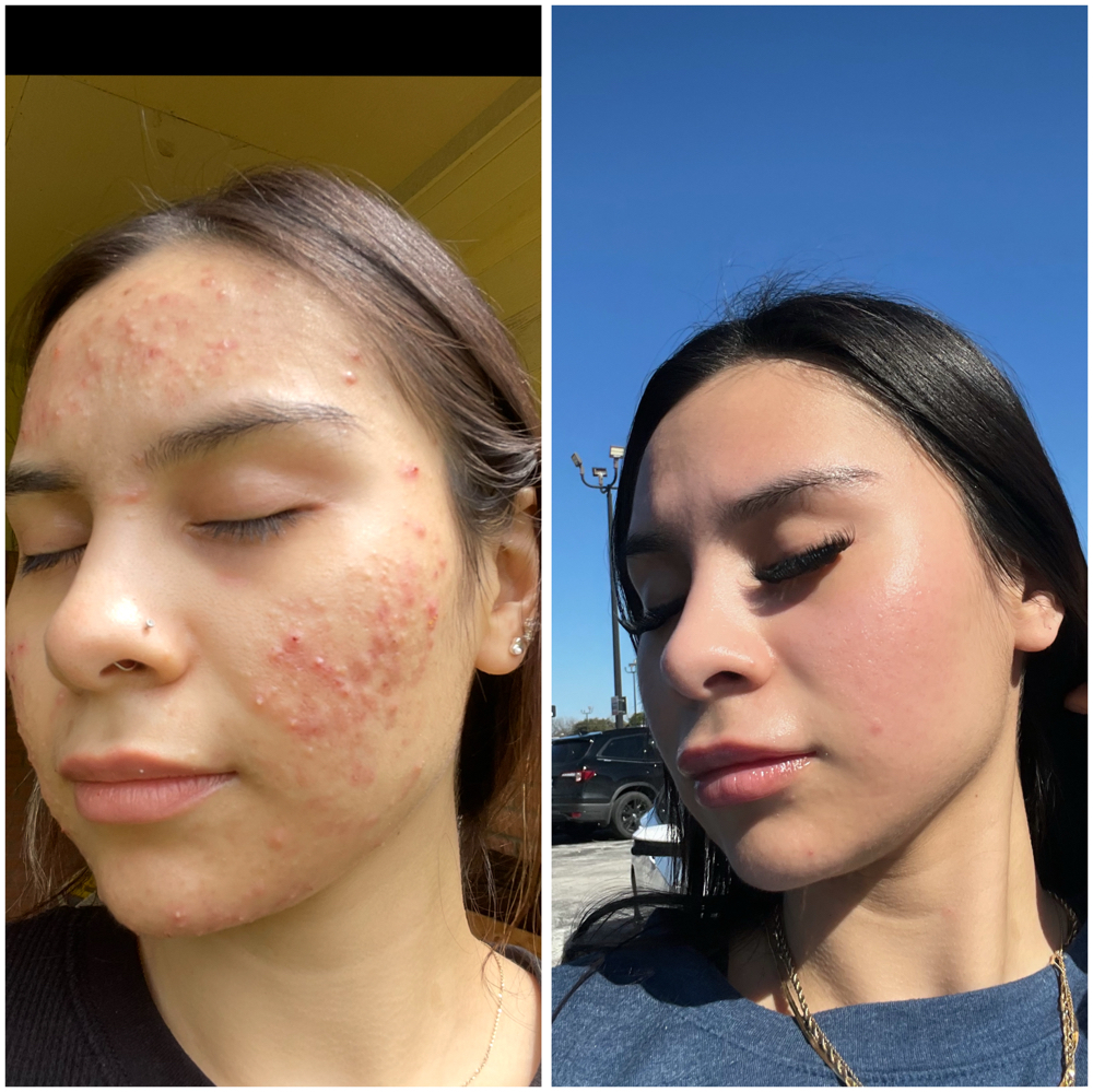 LA Rx Clear Skin Acne Facial