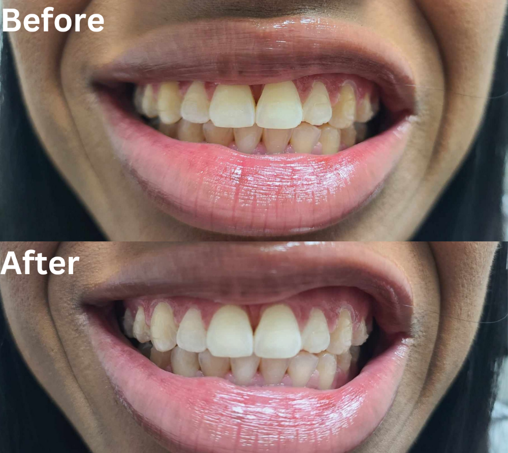 Teeth Whitening Maintenance