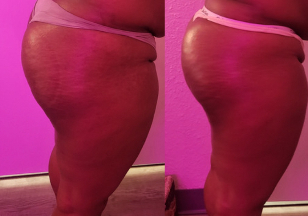 BBL Sculpt: Booty Contour at Swani Massage and Bodywork in Fort Worth, TX