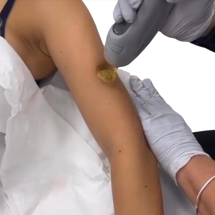 Laser hair Removal (XXL Area)