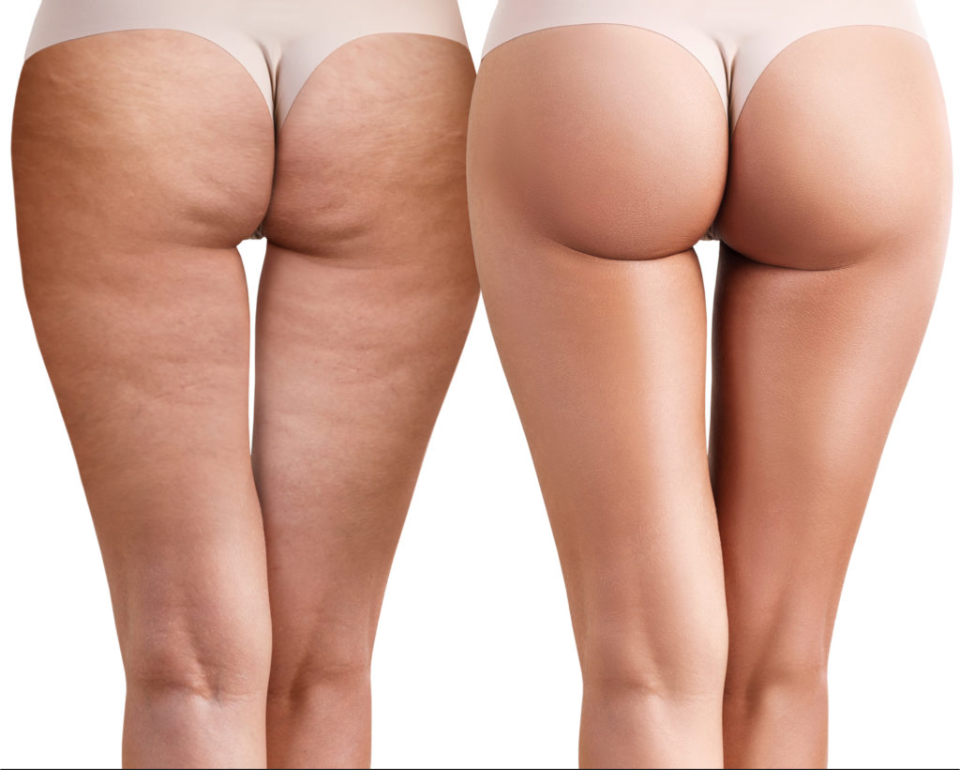 Melt The Cellulite Thigh