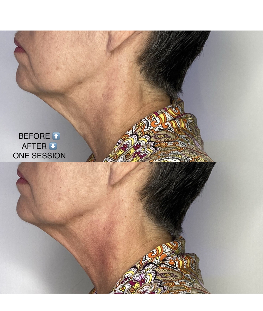 CryoSlimming - Small Area