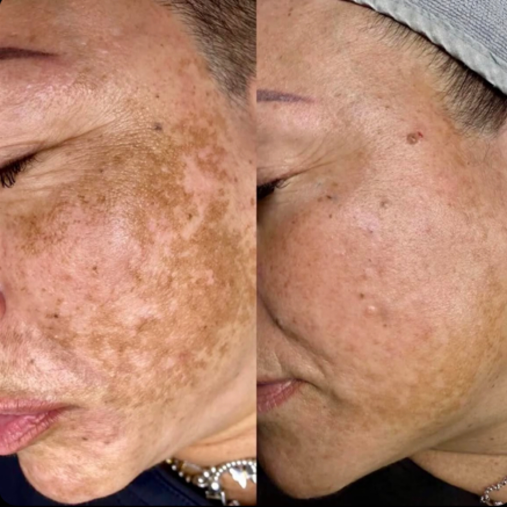 MelaPro Cold Peel at Haylee Jade Esthetics LLC in Ellijay, GA