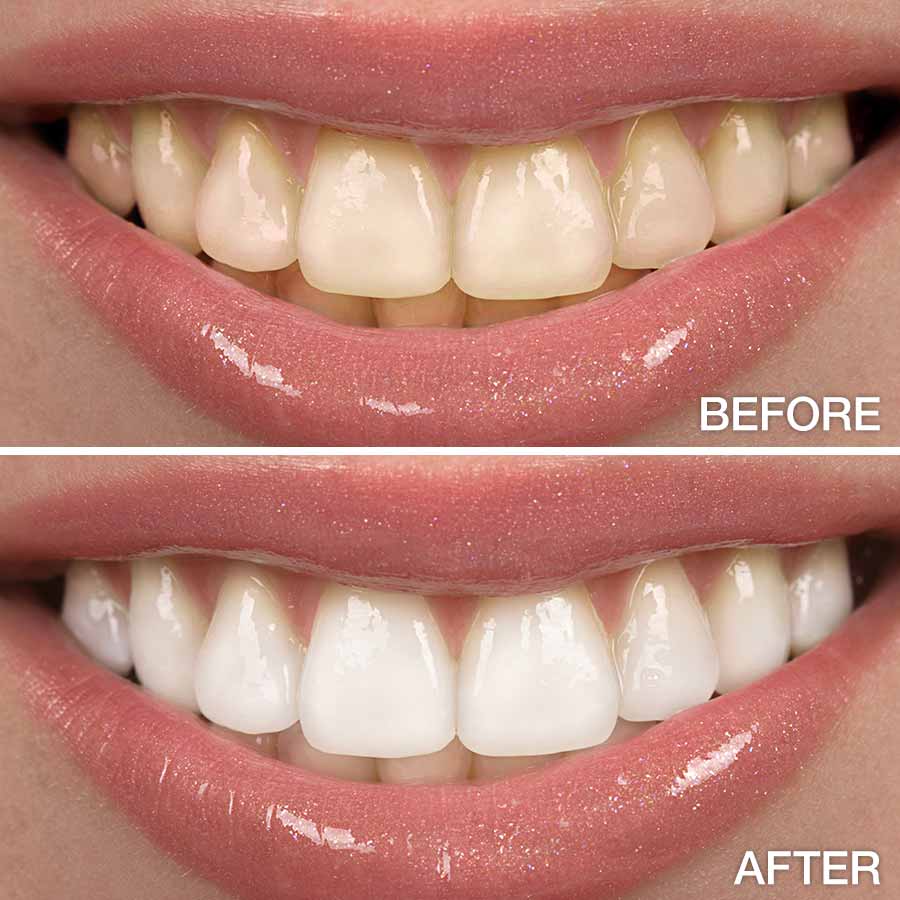 Cosmetic Teeth Whitening 90 min