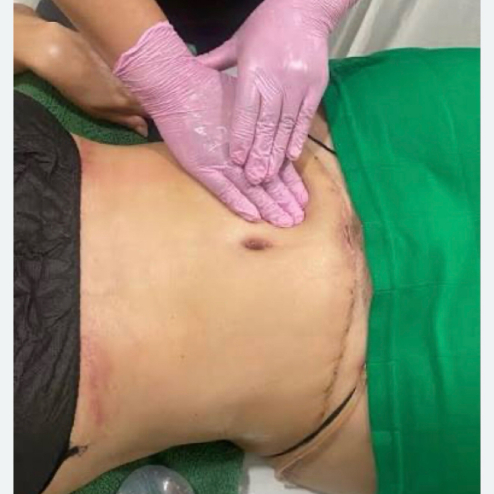 Post-Operatorios Con Drenaje Linfa at Any Beauty Aesthetics Care in New York, NY