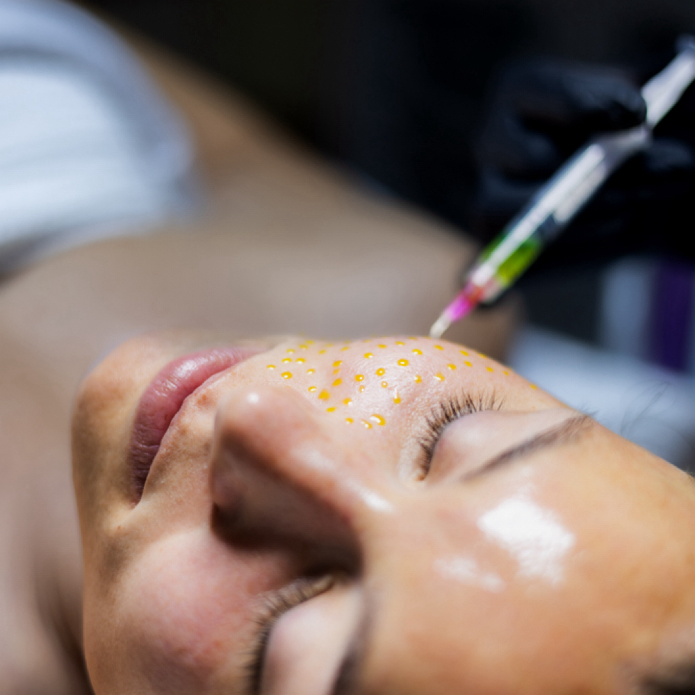 BioRePeel at Jade Esthetics in Oviedo, FL