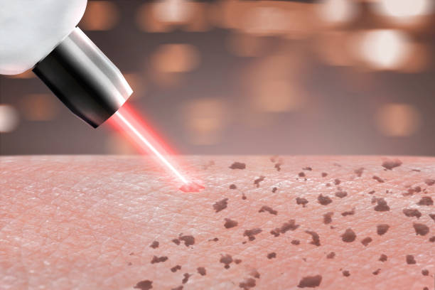 Pack Laser tattoo removal