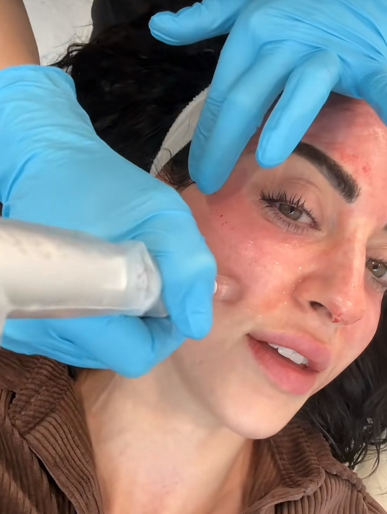 Exosomas PDRN Microneedling