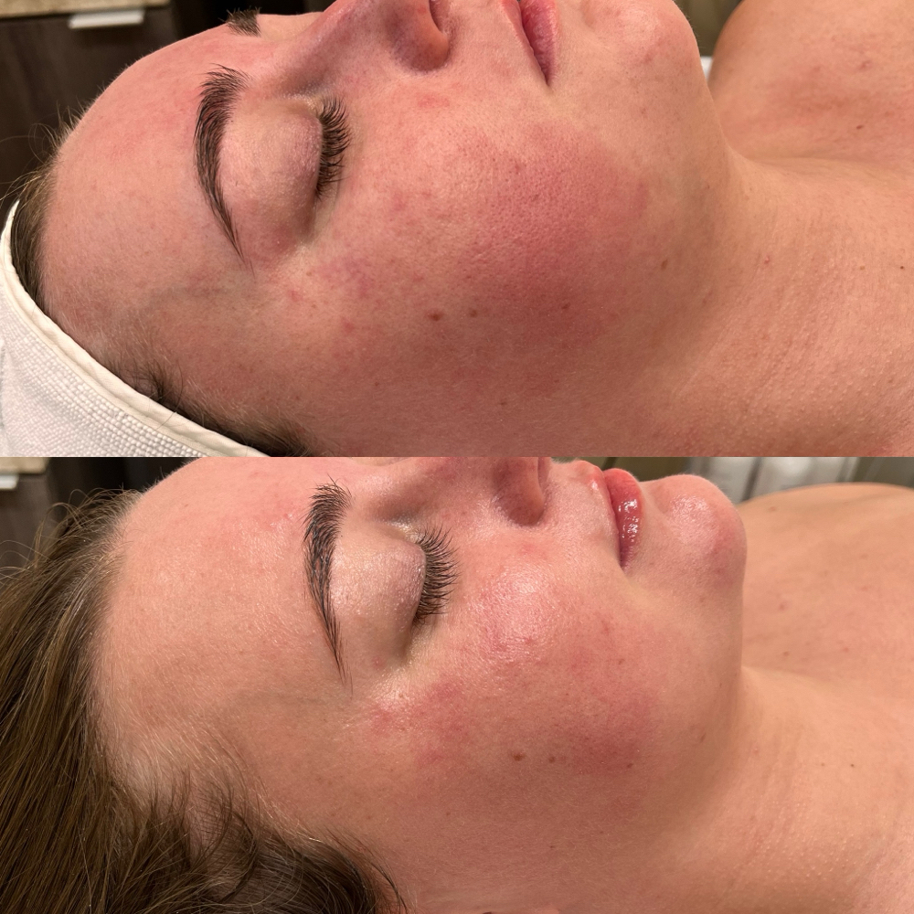 RDS Peel Facial at The Bella Angel Glow in Farmingdale, NY