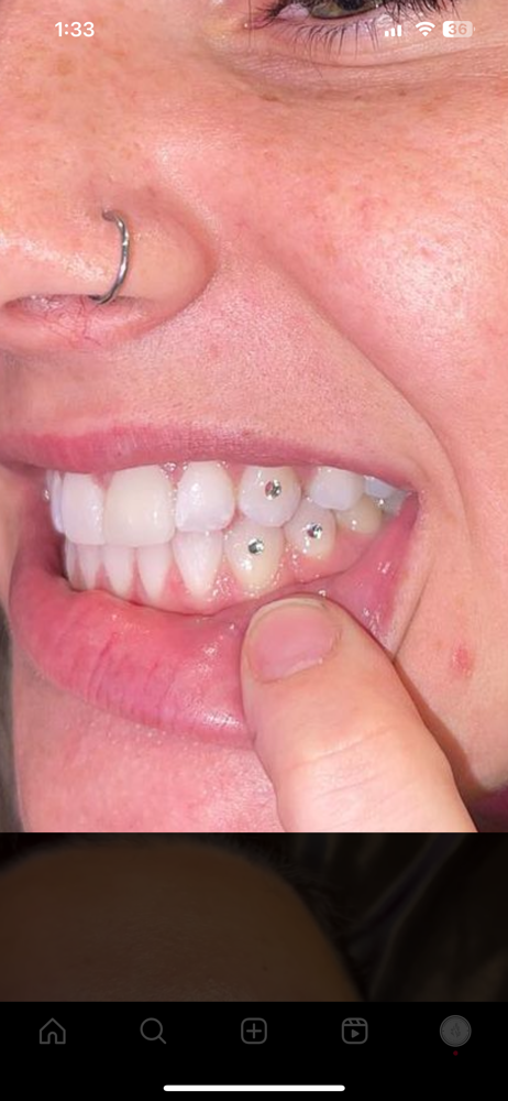 Tooth Gem (1)