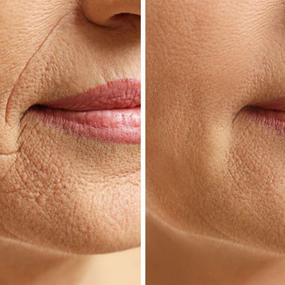 Perioral Filler (smokers Lines) at Monroe’s Everlasting Beauty in Corpus Christi, TX