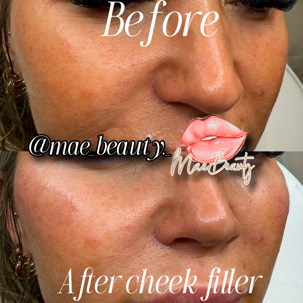 Cheek Fillers Enhancement at MaeBeauty in Mesquite, TX