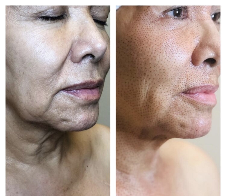 Full Facial Fibroblast Treatment