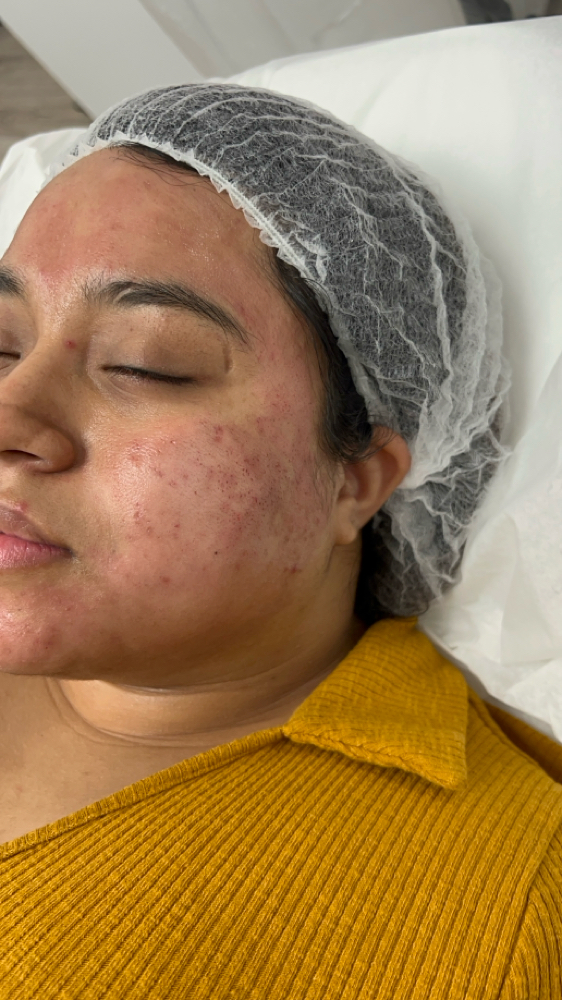 Acne Scar Removal Treatment
