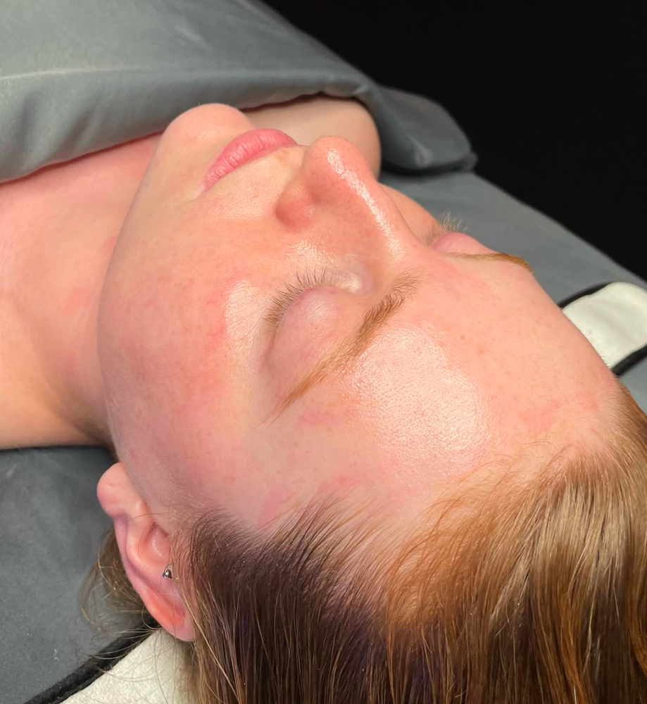 Deluxe Chemical Peel