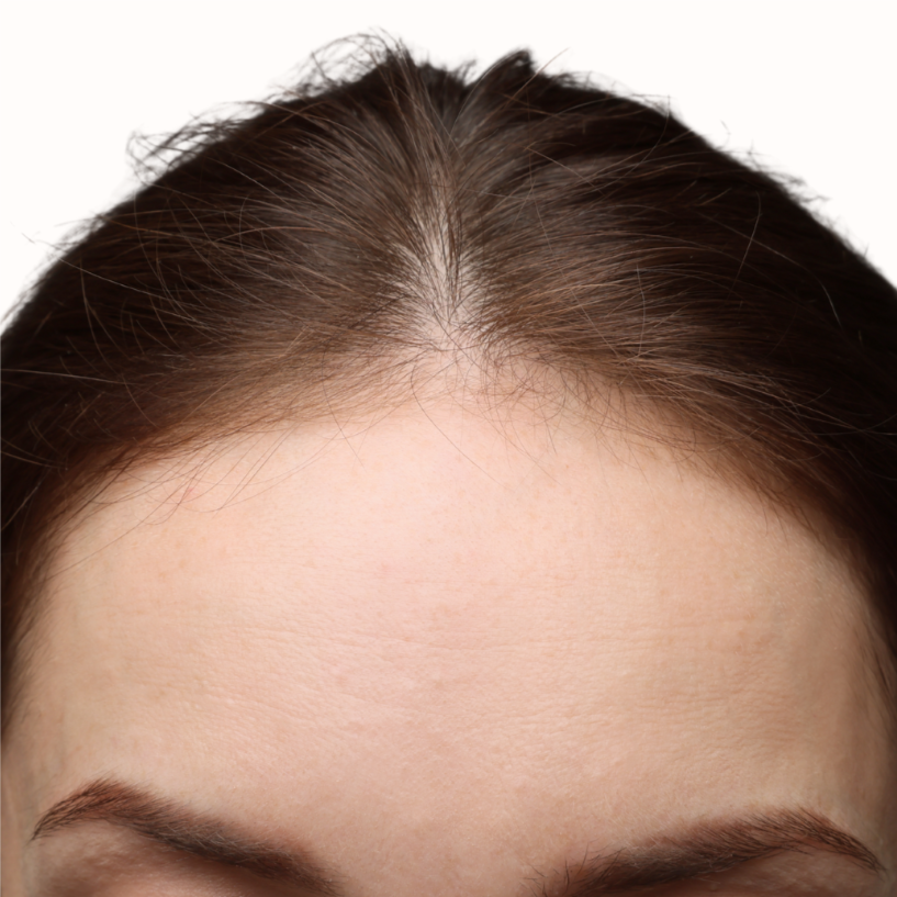 Hairline at Bareline Aesthetics in Brea, CA