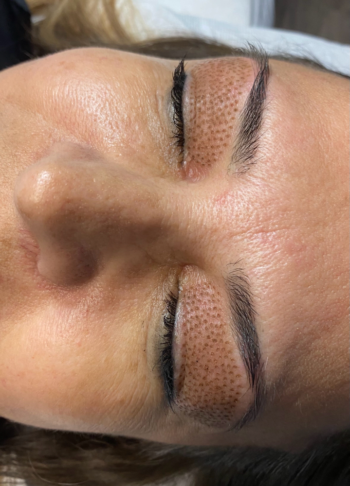 Plasma Fibroblast Upper Eyelids