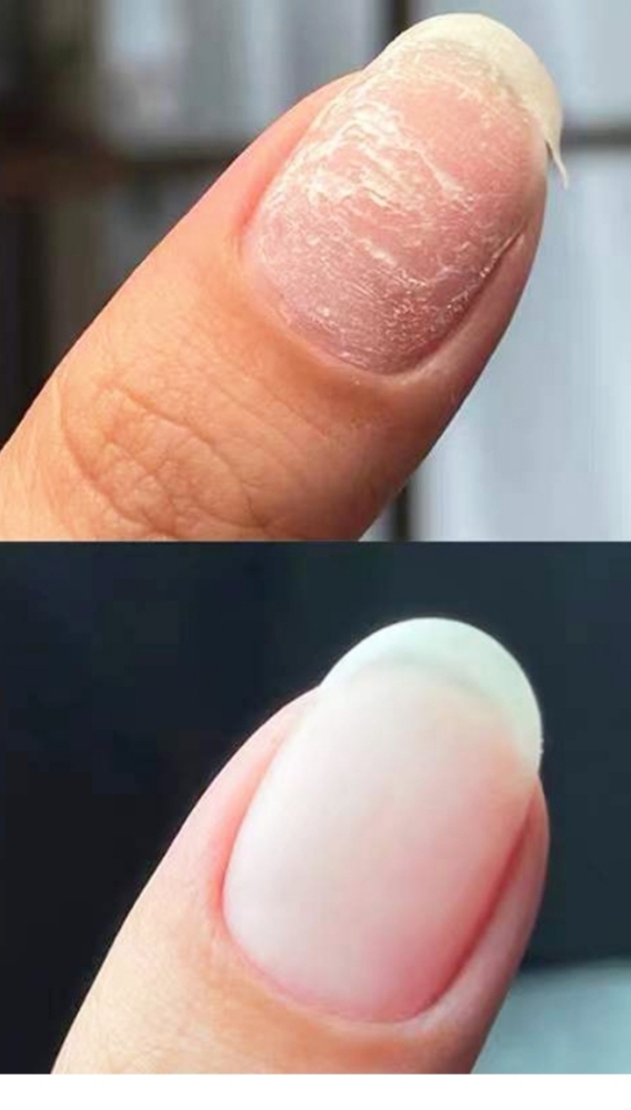Nail Repair