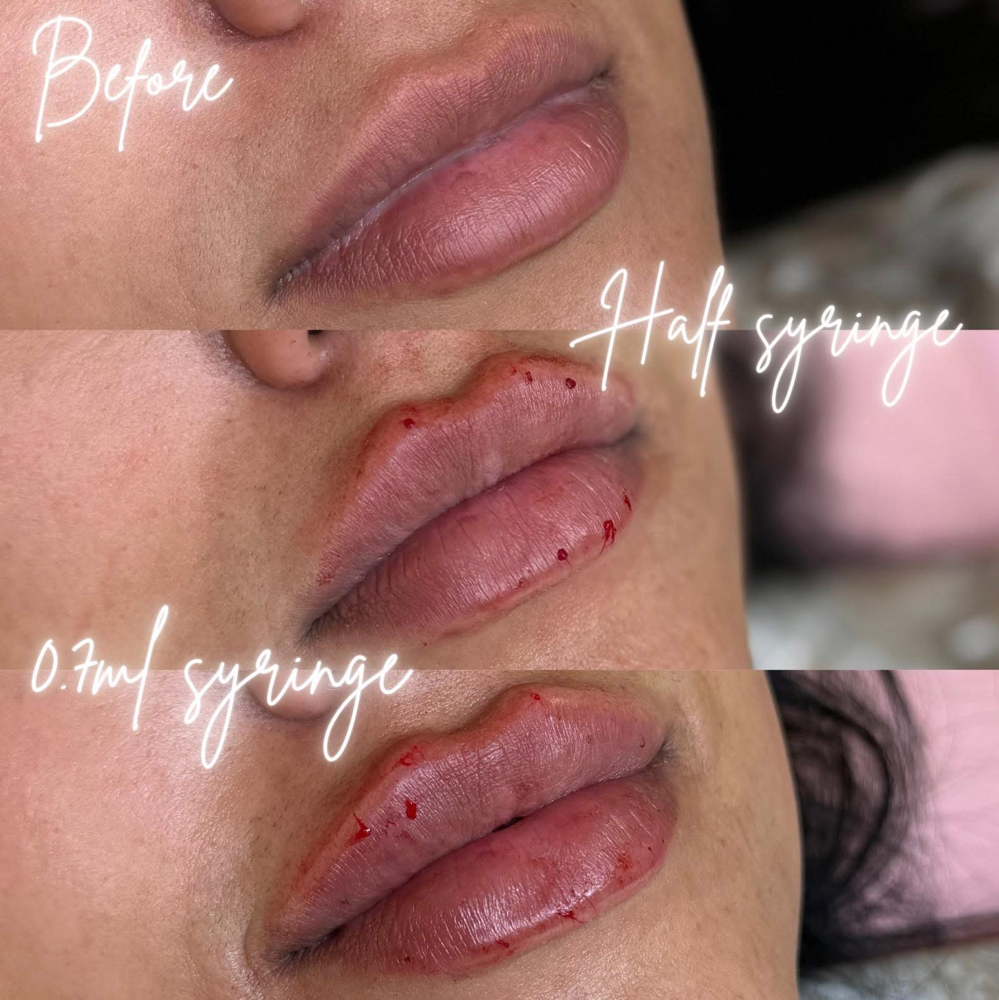 0.7ML Dermal Lip Filler💋💉 at BeautyHolic Aesthetics LLC in Lubbock, TX