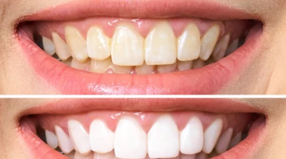 New Service - Teeth Whitening!!!