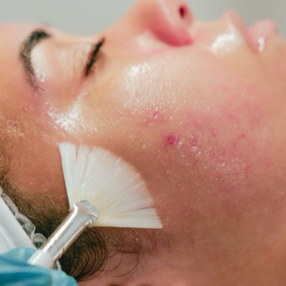 The Clarity Peel / Salicylic at ComplexionbyCali in South Jordan, UT