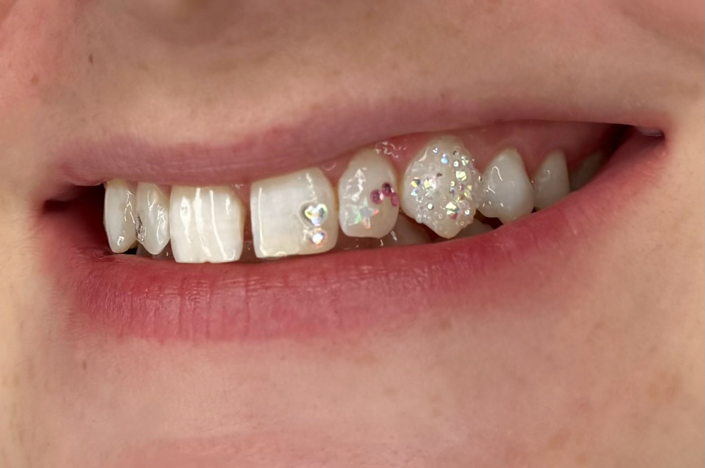 Mini freestyle set- 3-5 Teeth Max