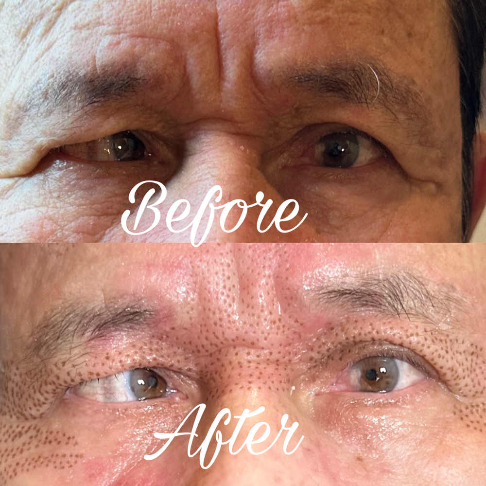 Upper Eyelids Lift