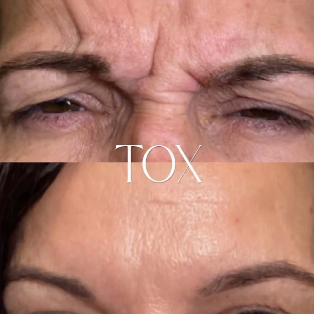 Botox Injections • Kensey at Vibez & Vanity Salon in Tucson, AZ