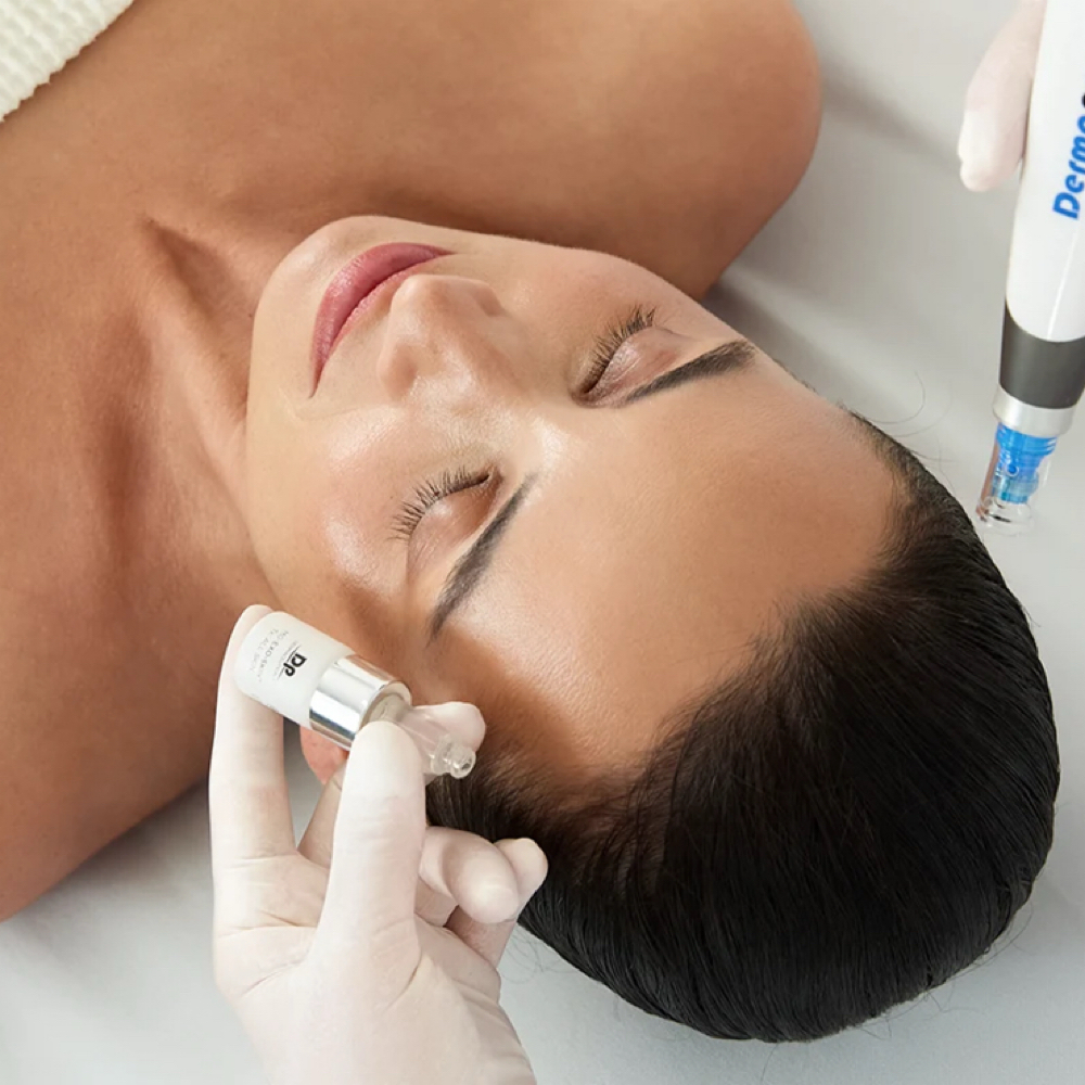 Microneedling - Face + Neck at The Fishers Esthetician in Fishers, IN