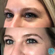 Hydrofacial Perk Eye Treatment